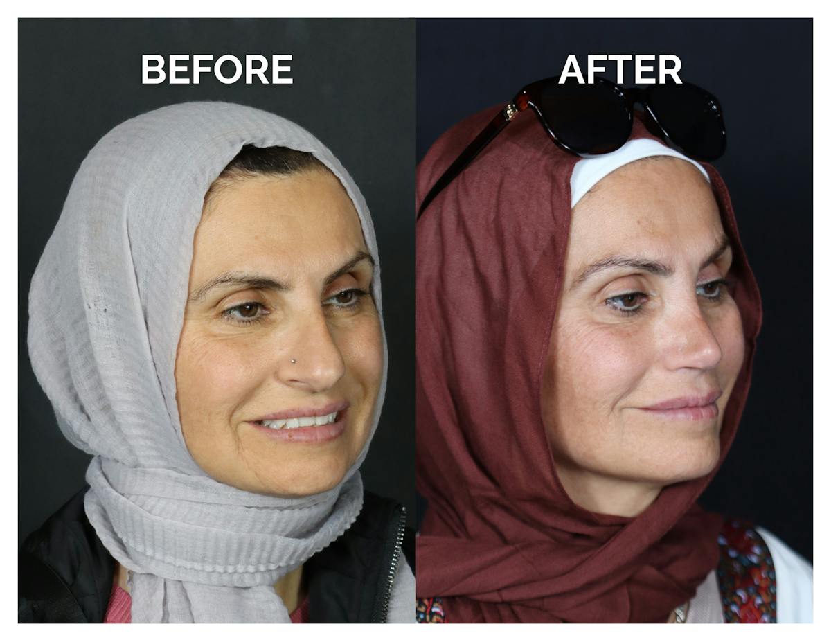 Rhinoplasty Before & After Gallery - Patient 370697 - Image 2