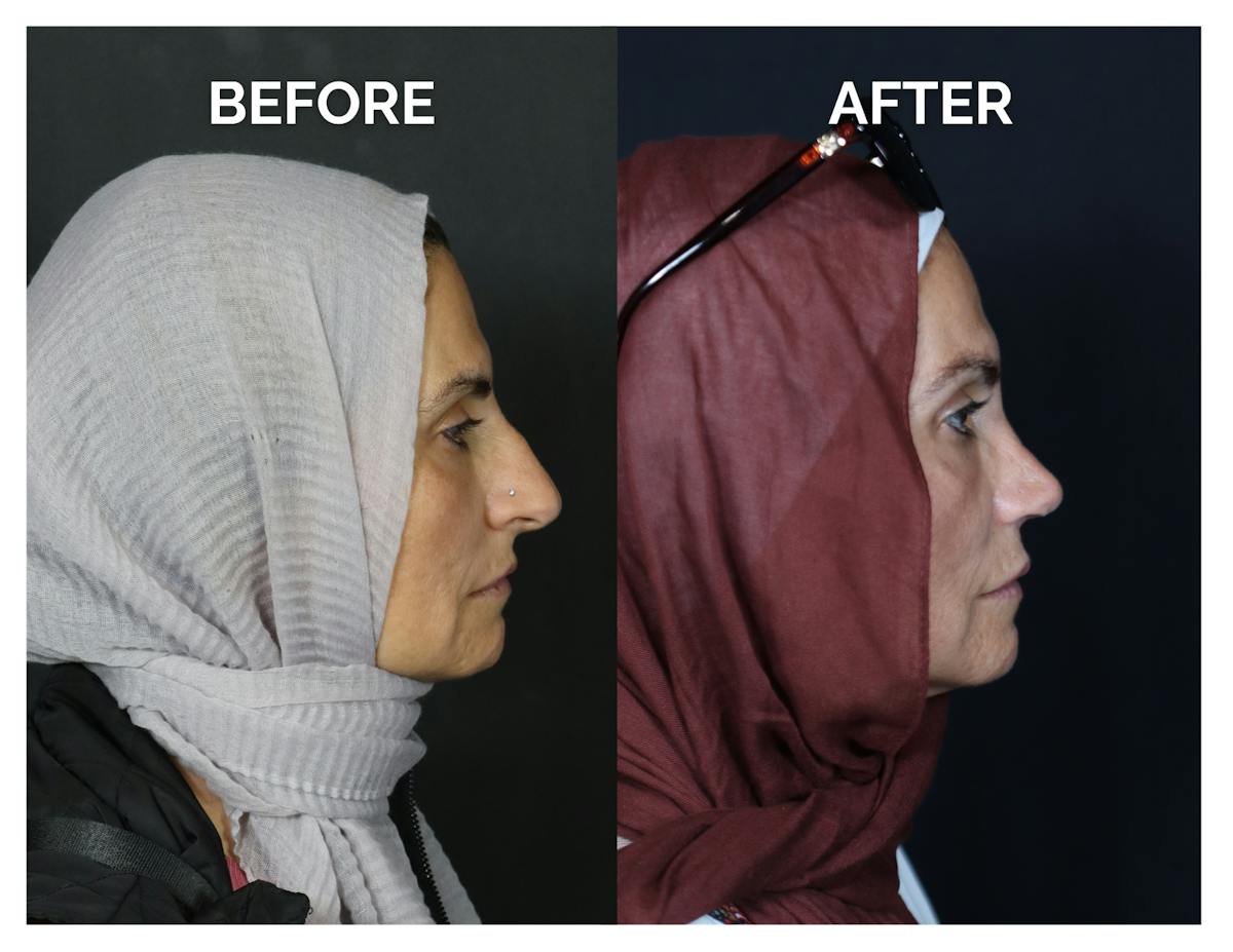 Rhinoplasty Before & After Gallery - Patient 370697 - Image 3
