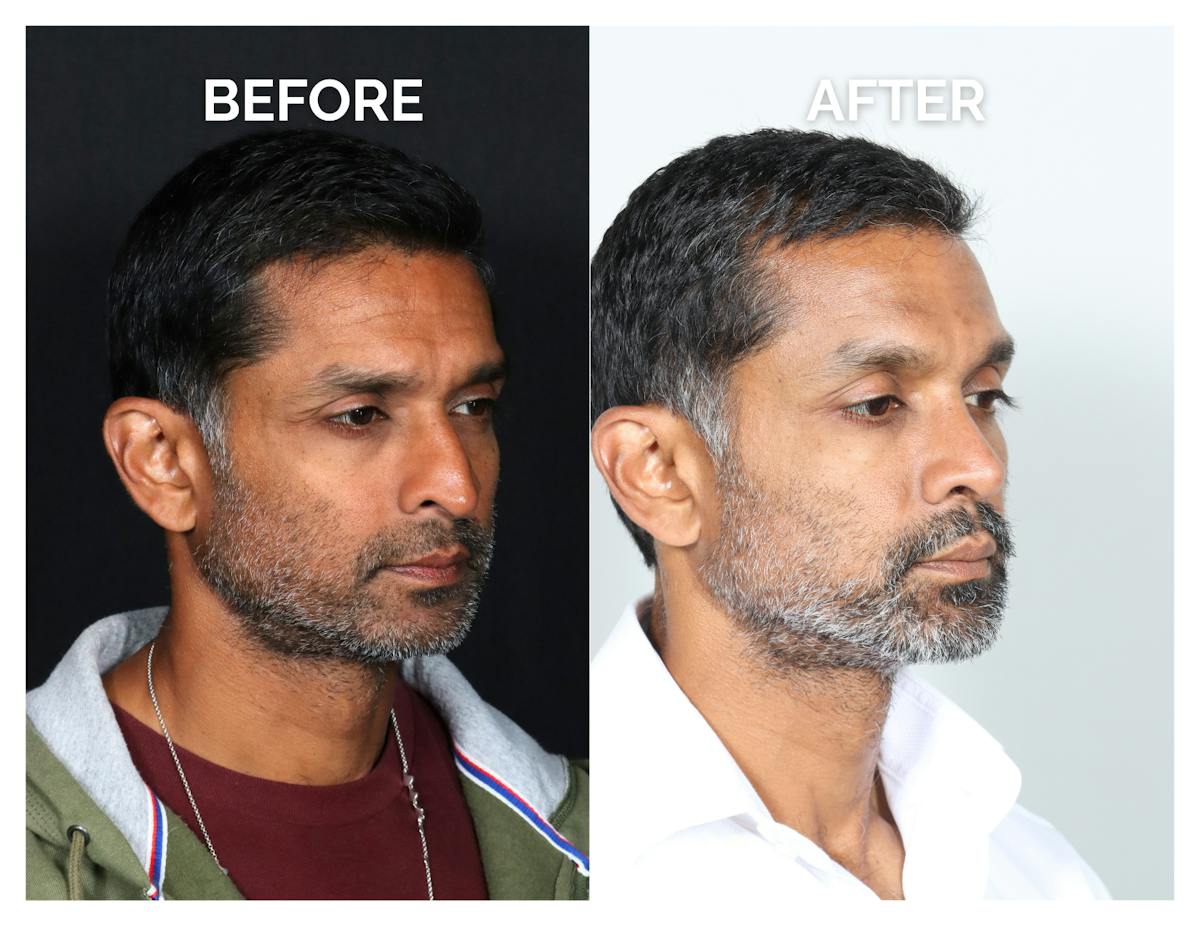 Rhinoplasty Before & After Gallery - Patient 323067 - Image 1