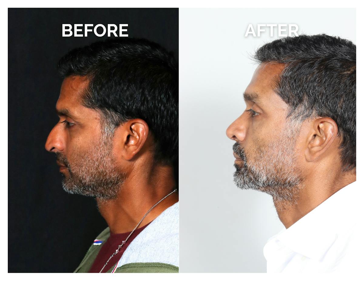 Rhinoplasty Before & After Gallery - Patient 323067 - Image 3