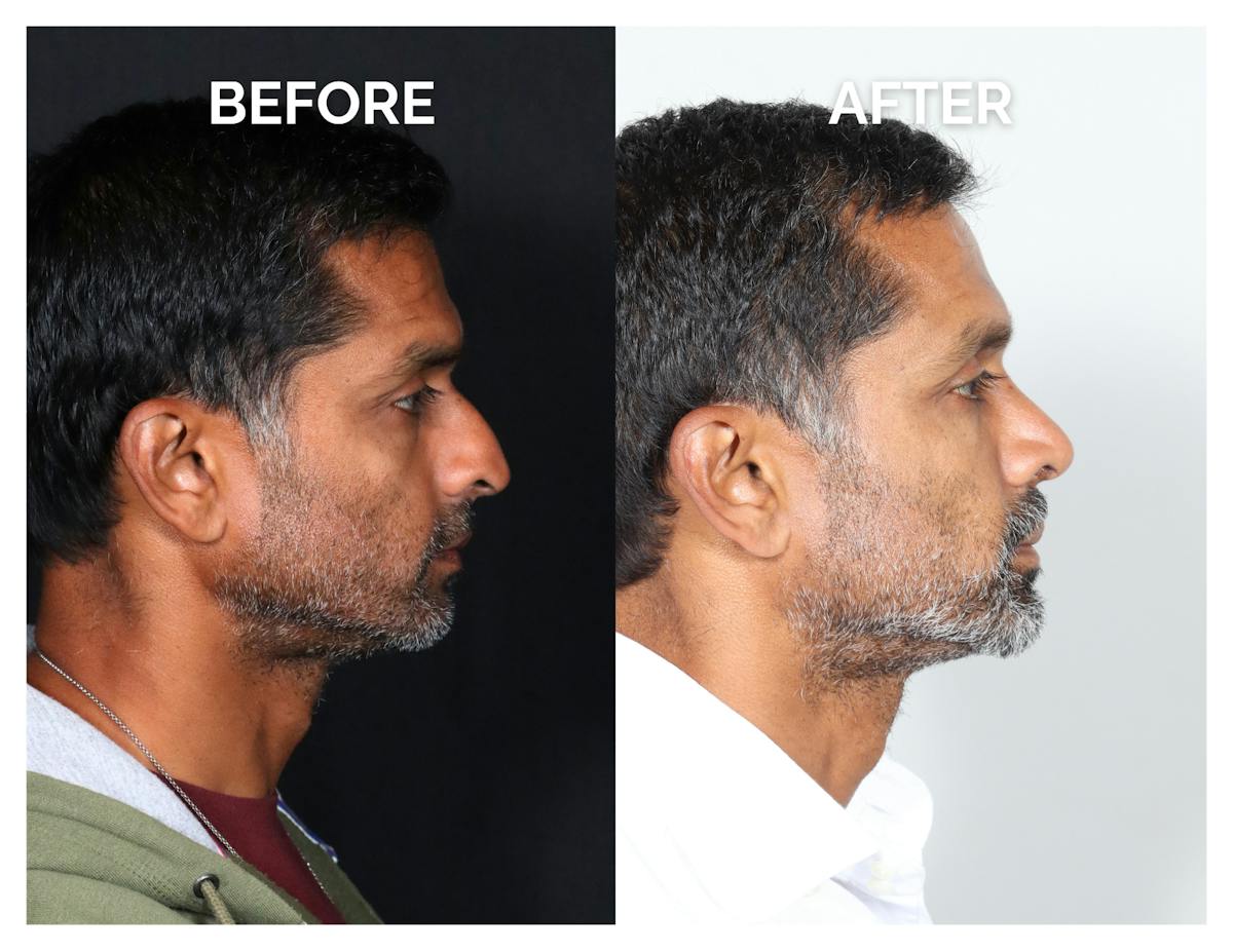 Rhinoplasty Before & After Gallery - Patient 323067 - Image 2
