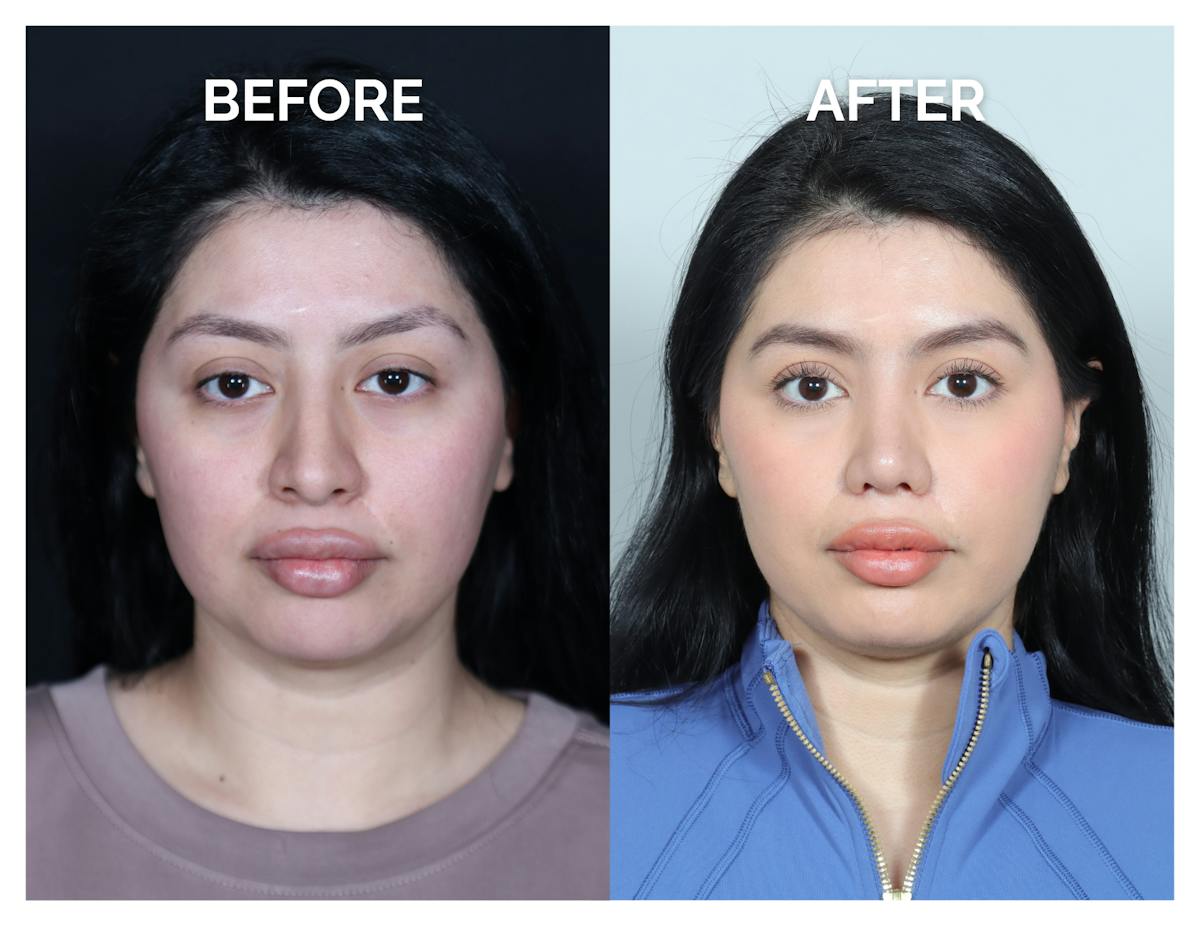 Rhinoplasty Before & After Gallery - Patient 528237 - Image 3