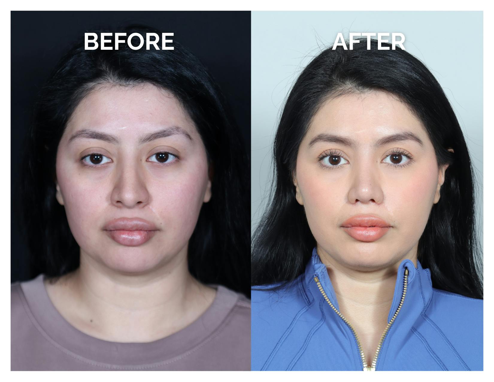 Rhinoplasty Before & After Gallery - Patient 528237 - Image 3