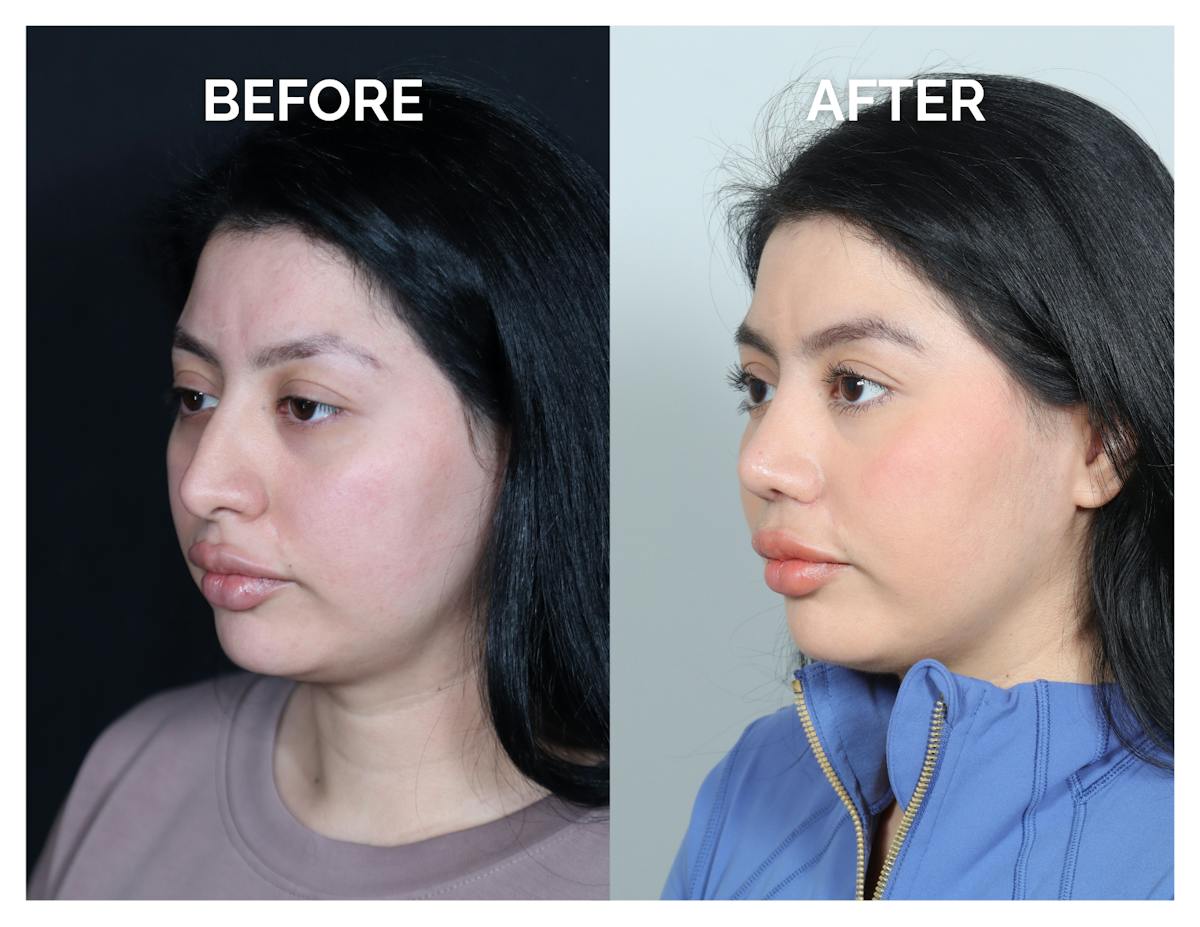 Rhinoplasty Before & After Gallery - Patient 528237 - Image 6