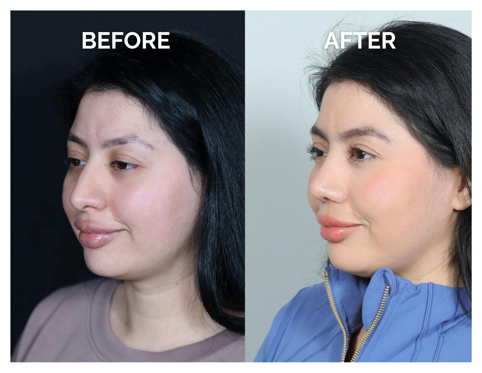 Rhinoplasty Before & After Gallery - Patient 528237 - Image 5
