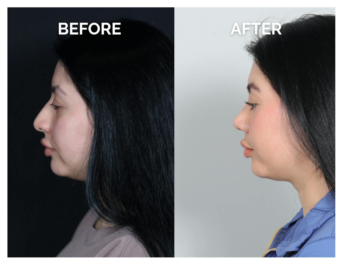 Rhinoplasty Before & After Gallery - Patient 528237 - Image 4
