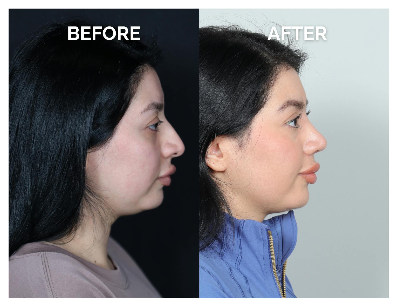 Rhinoplasty Before & After Gallery - Patient 528237 - Image 2
