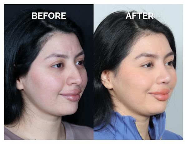 Rhinoplasty Before & After Gallery - Patient 528237 - Image 1