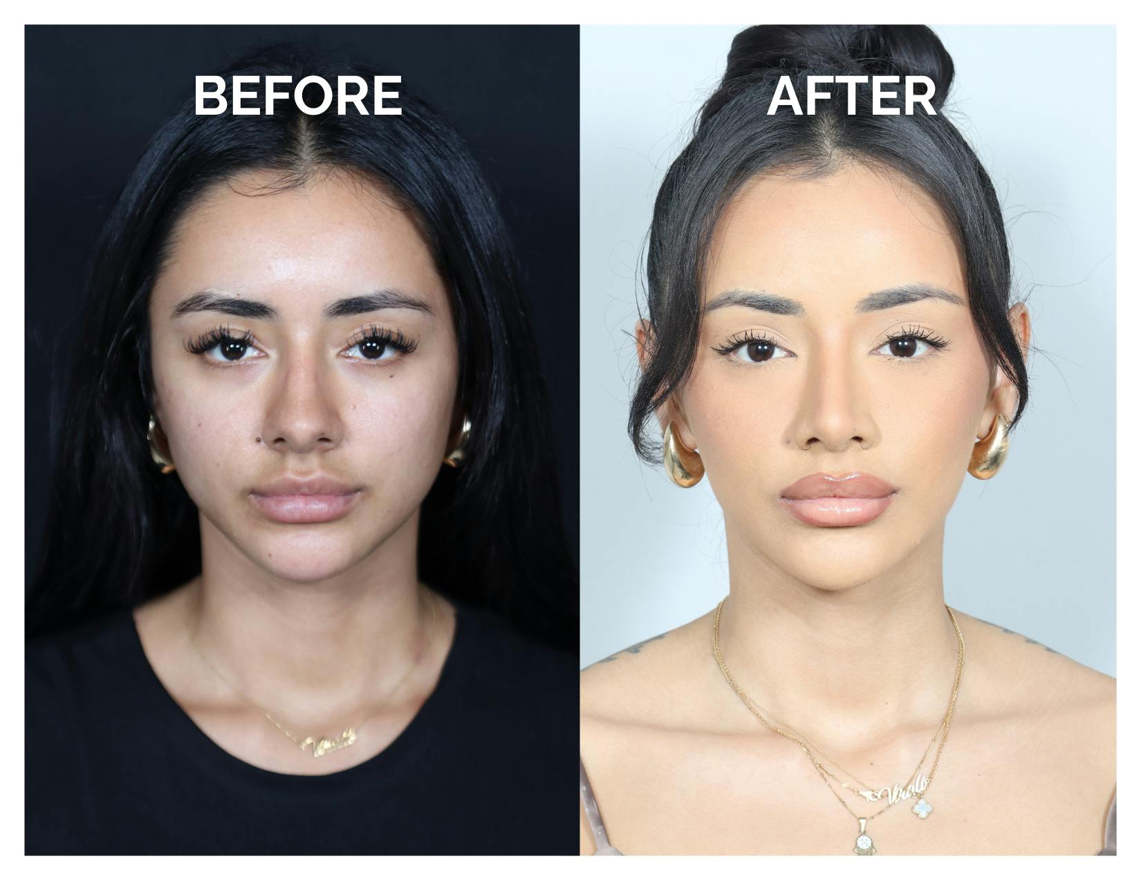 Rhinoplasty Before & After Gallery - Patient 156730 - Image 4