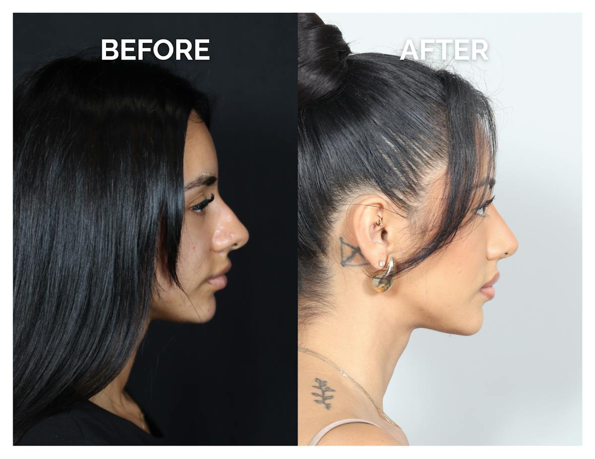 Rhinoplasty Before & After Gallery - Patient 156730 - Image 3