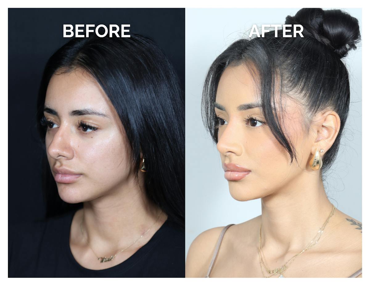 Rhinoplasty Before & After Gallery - Patient 156730 - Image 5