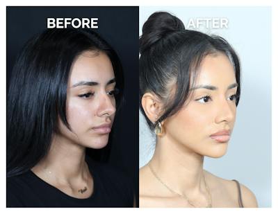 Rhinoplasty Before & After Gallery - Patient 156730 - Image 1