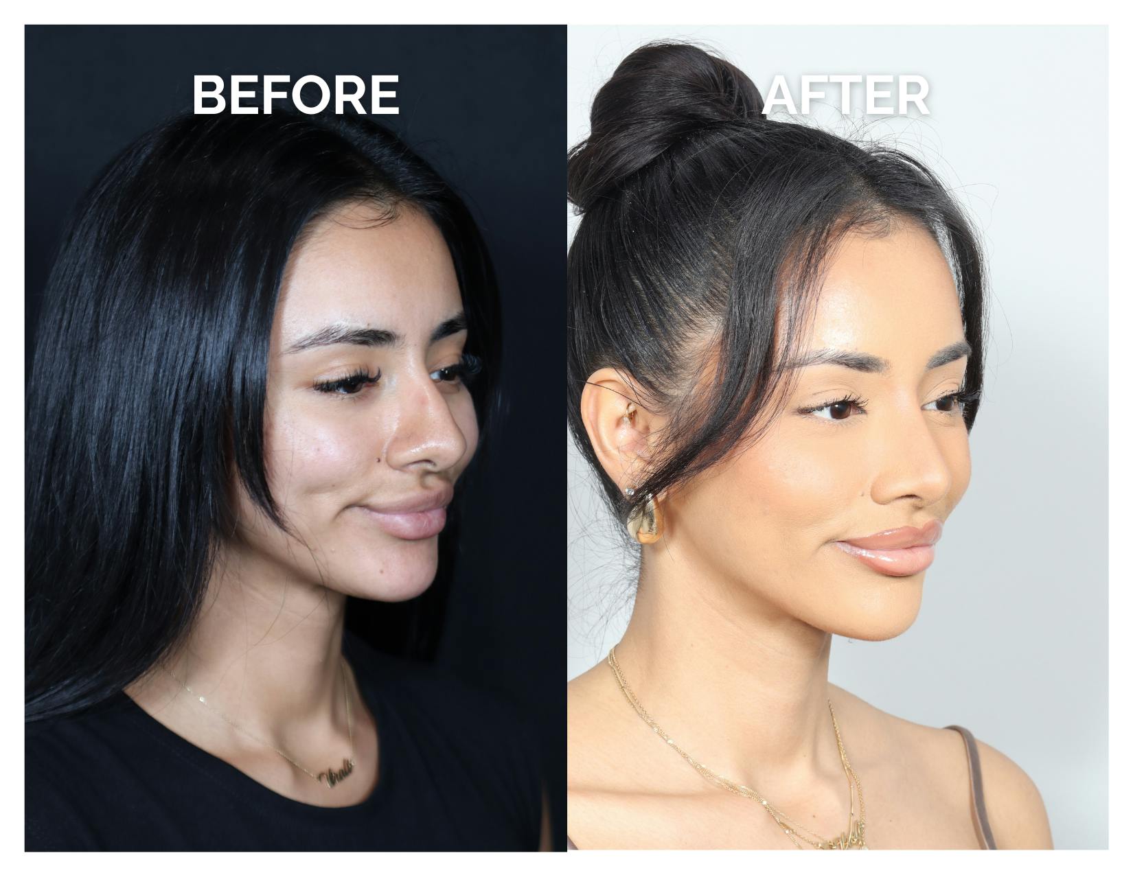 Rhinoplasty Before & After Gallery - Patient 156730 - Image 2
