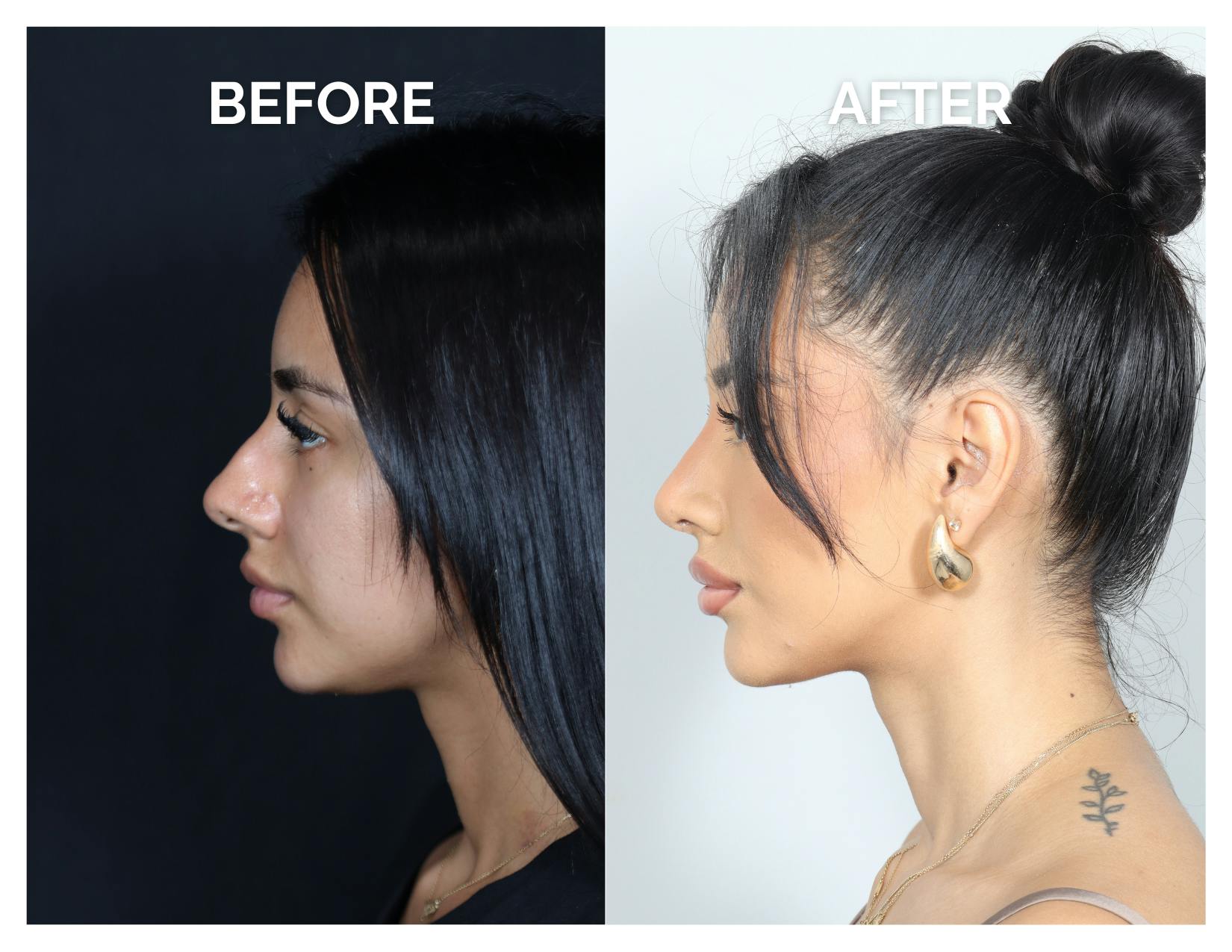 Rhinoplasty Before & After Gallery - Patient 156730 - Image 6