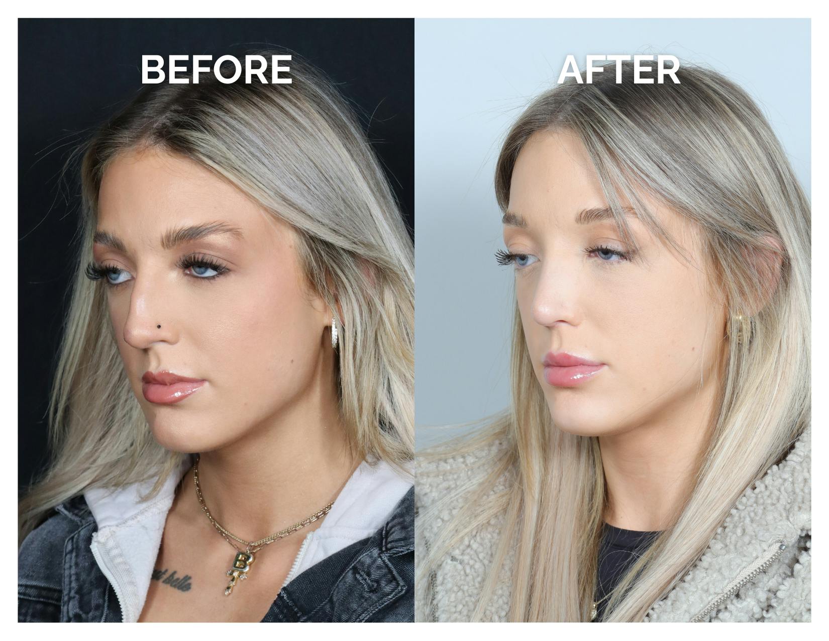 Rhinoplasty Before & After Gallery - Patient 101428 - Image 6