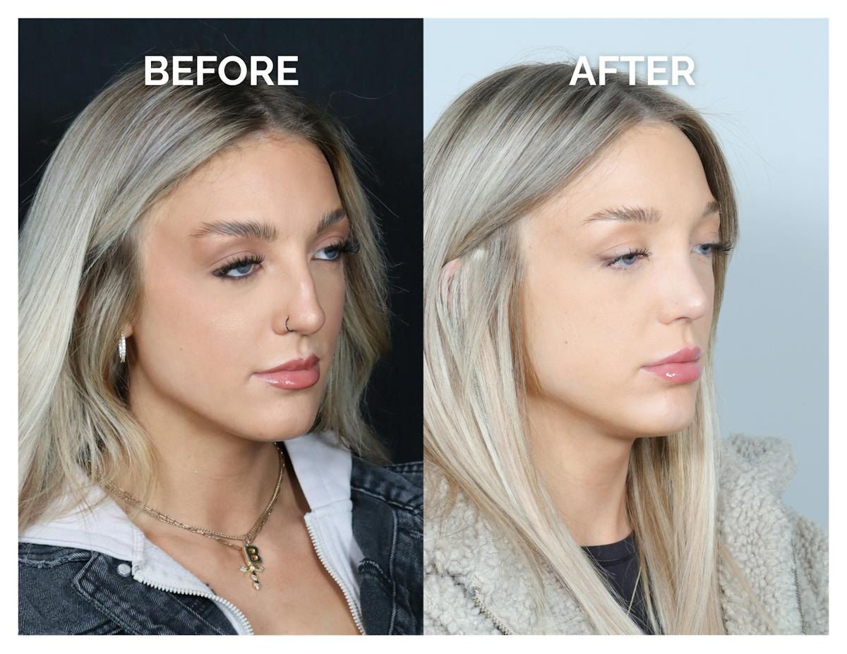 Rhinoplasty Before & After Gallery - Patient 101428 - Image 1