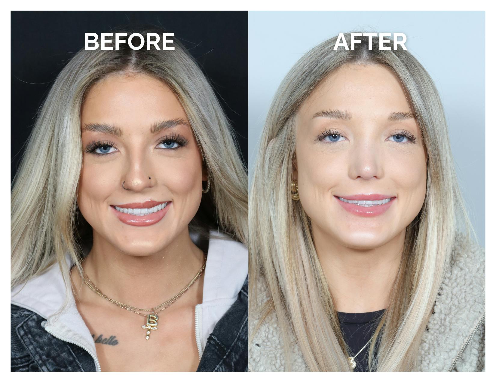 Rhinoplasty Before & After Gallery - Patient 101428 - Image 5