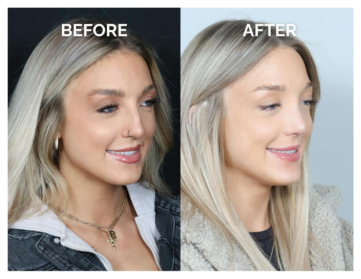 Rhinoplasty Before & After Gallery - Patient 101428 - Image 2