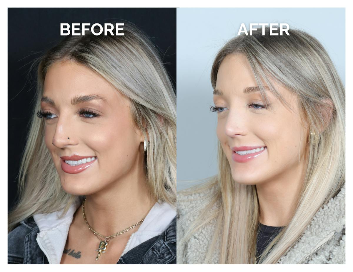 Rhinoplasty Before & After Gallery - Patient 101428 - Image 7