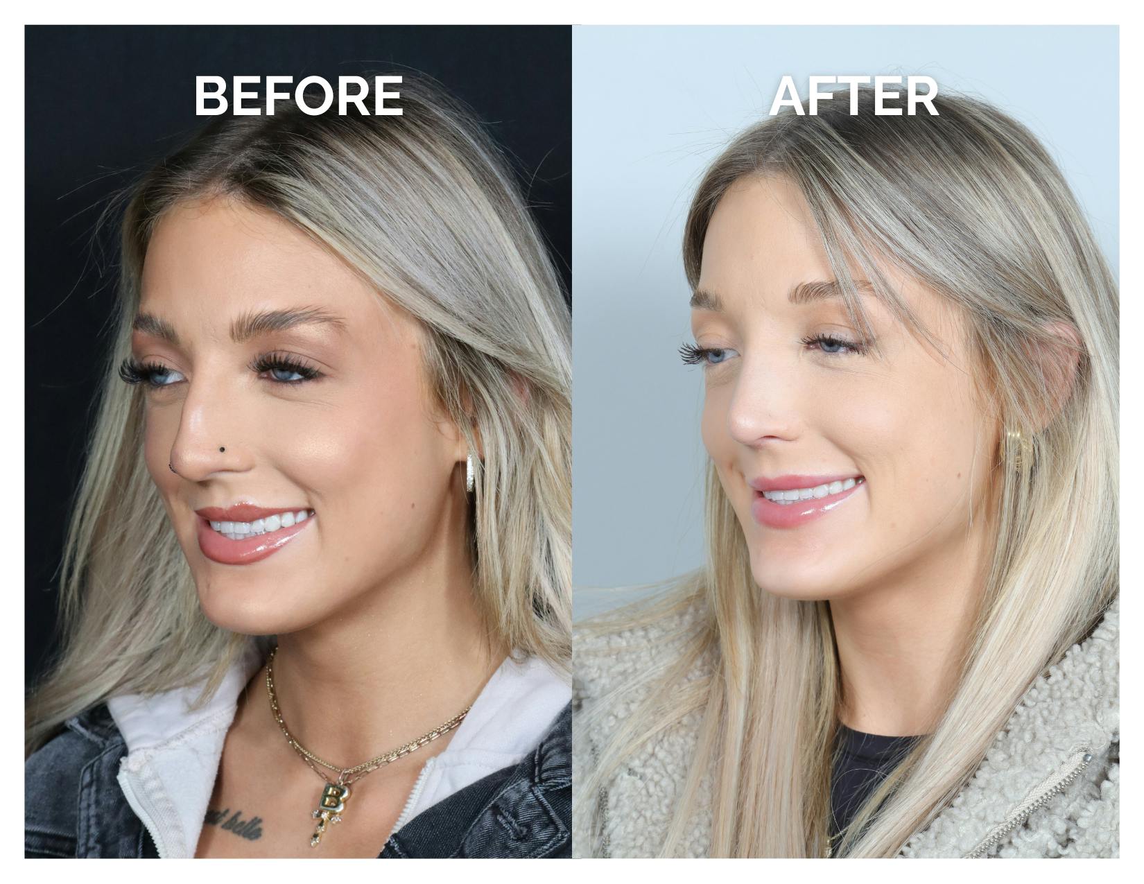 Rhinoplasty Before & After Gallery - Patient 101428 - Image 7