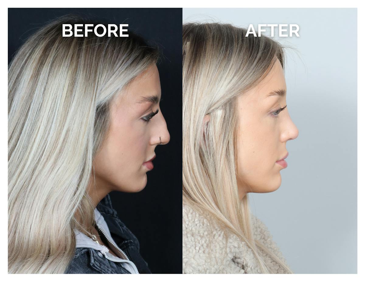 Rhinoplasty Before & After Gallery - Patient 101428 - Image 3