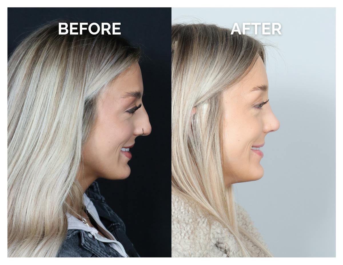 Rhinoplasty Before & After Gallery - Patient 101428 - Image 4