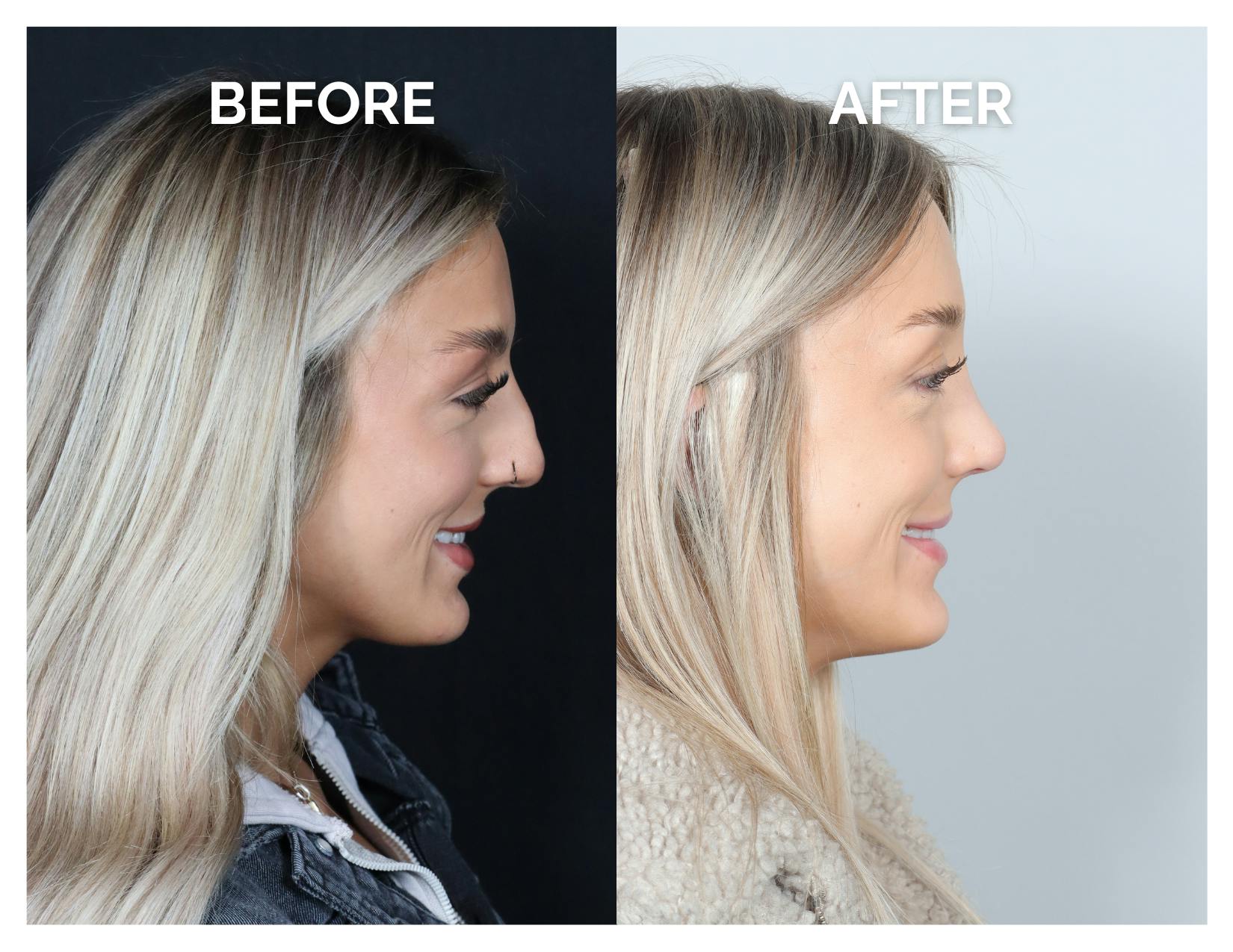 Rhinoplasty Before & After Gallery - Patient 101428 - Image 4
