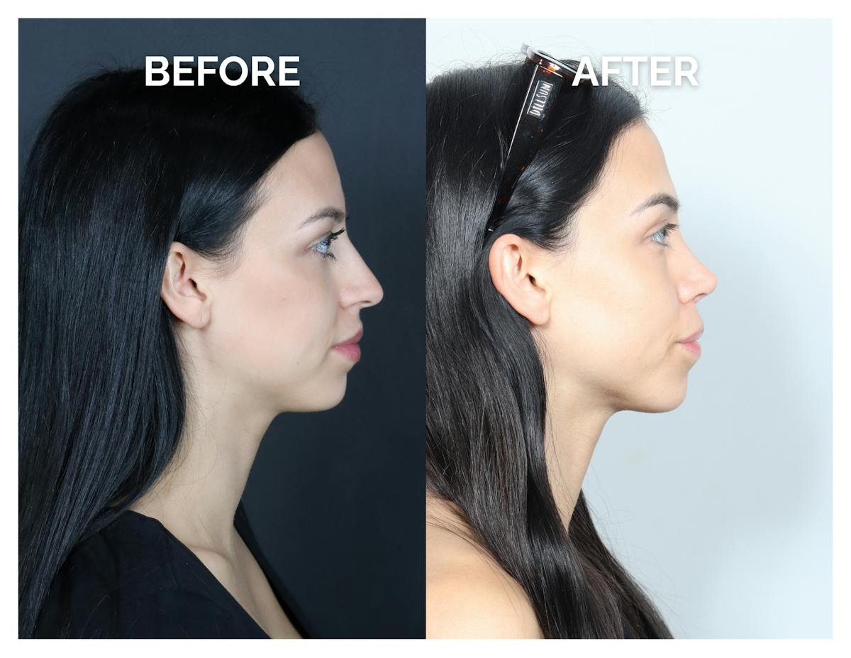 Rhinoplasty Before & After Gallery - Patient 345056 - Image 4