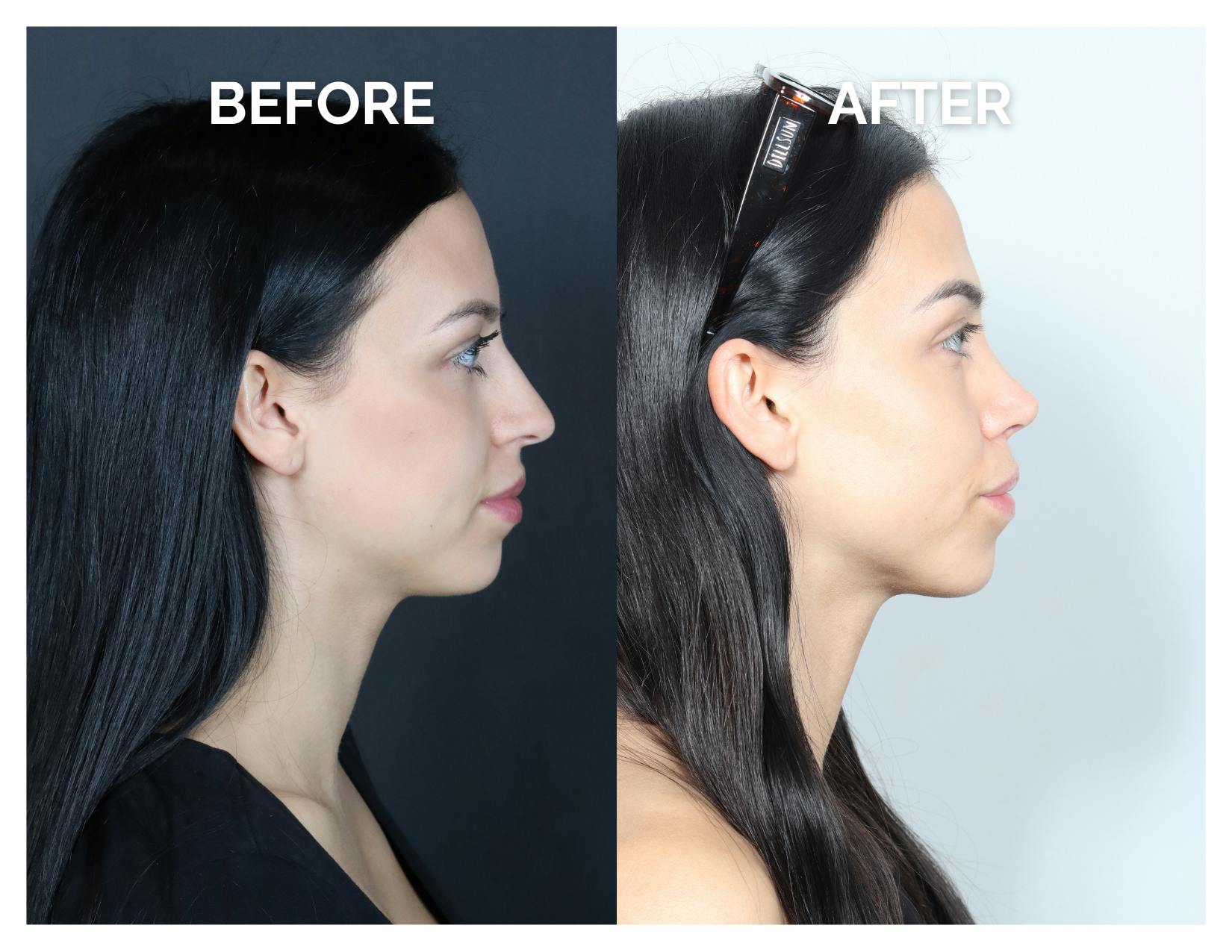 Rhinoplasty Before & After Gallery - Patient 345056 - Image 4