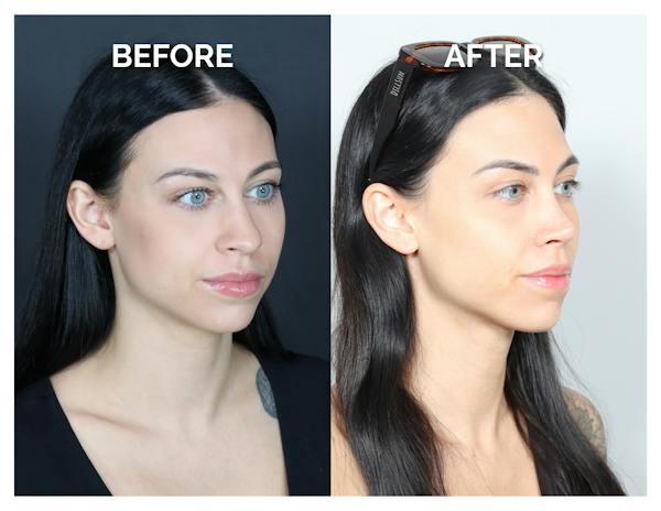 Rhinoplasty Before & After Gallery - Patient 345056 - Image 1