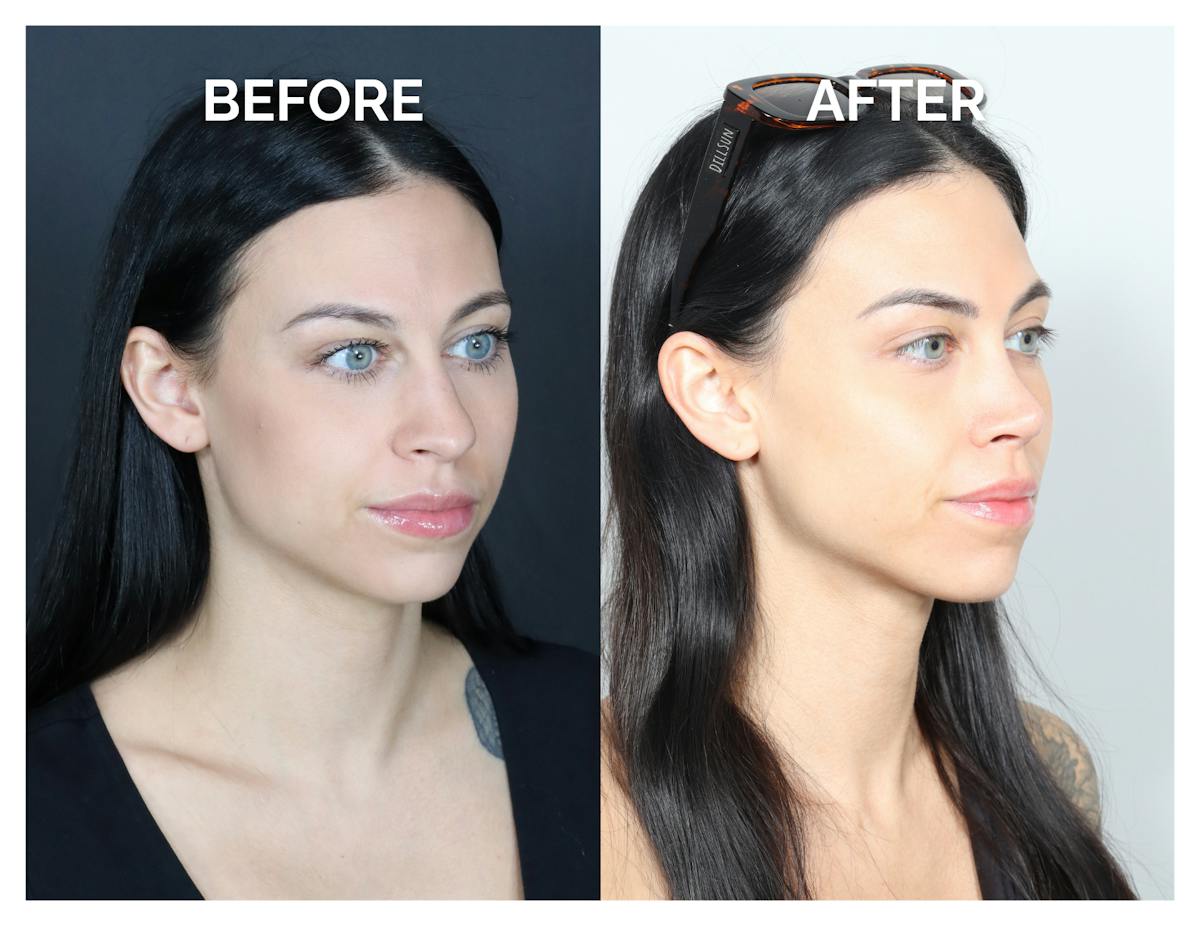 Rhinoplasty Before & After Gallery - Patient 345056 - Image 1