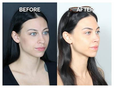 Rhinoplasty Before & After Gallery - Patient 345056 - Image 1