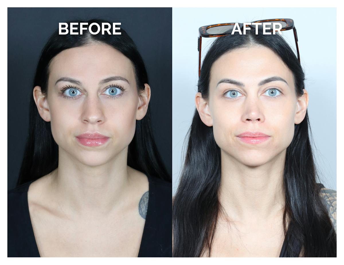 Rhinoplasty Before & After Gallery - Patient 345056 - Image 5