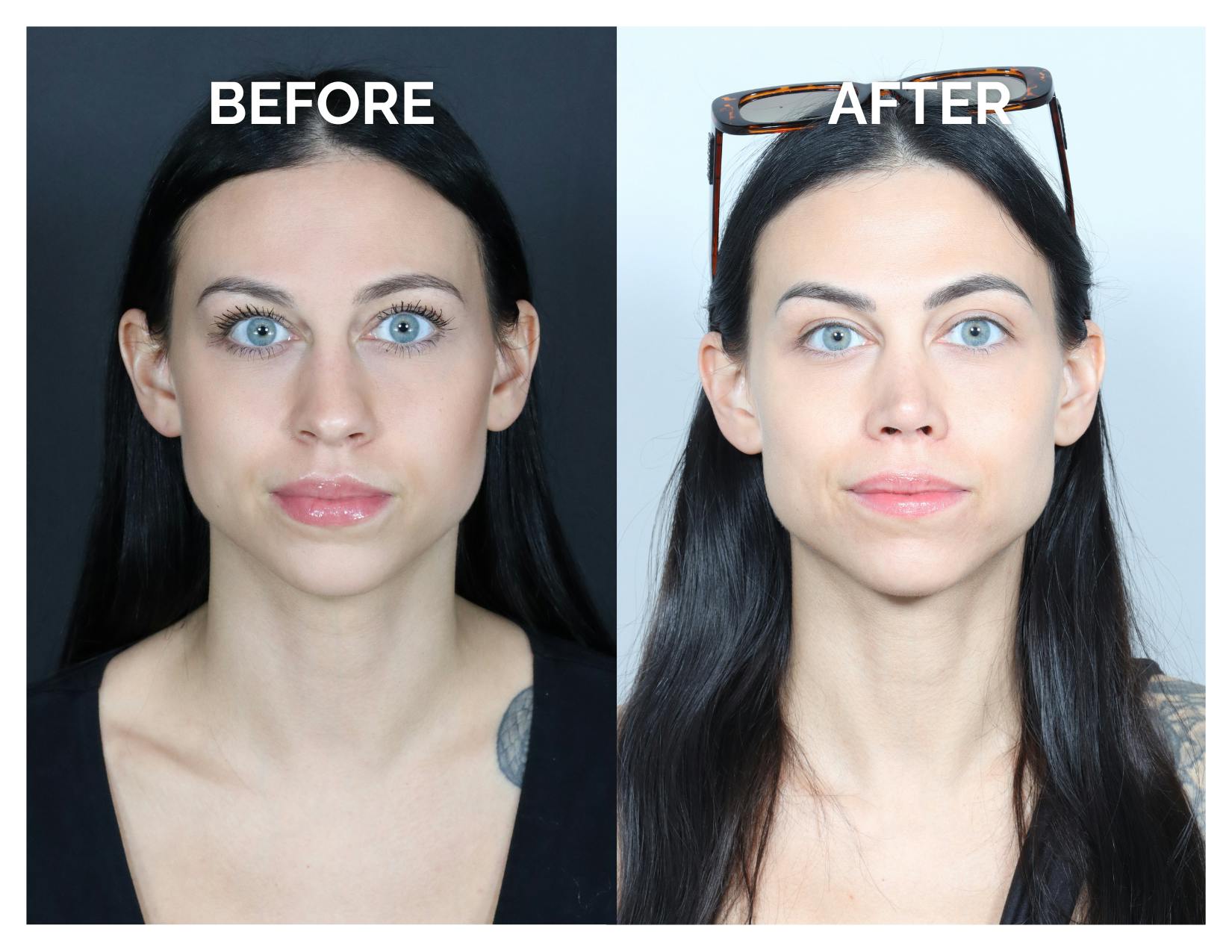 Rhinoplasty Before & After Gallery - Patient 345056 - Image 5