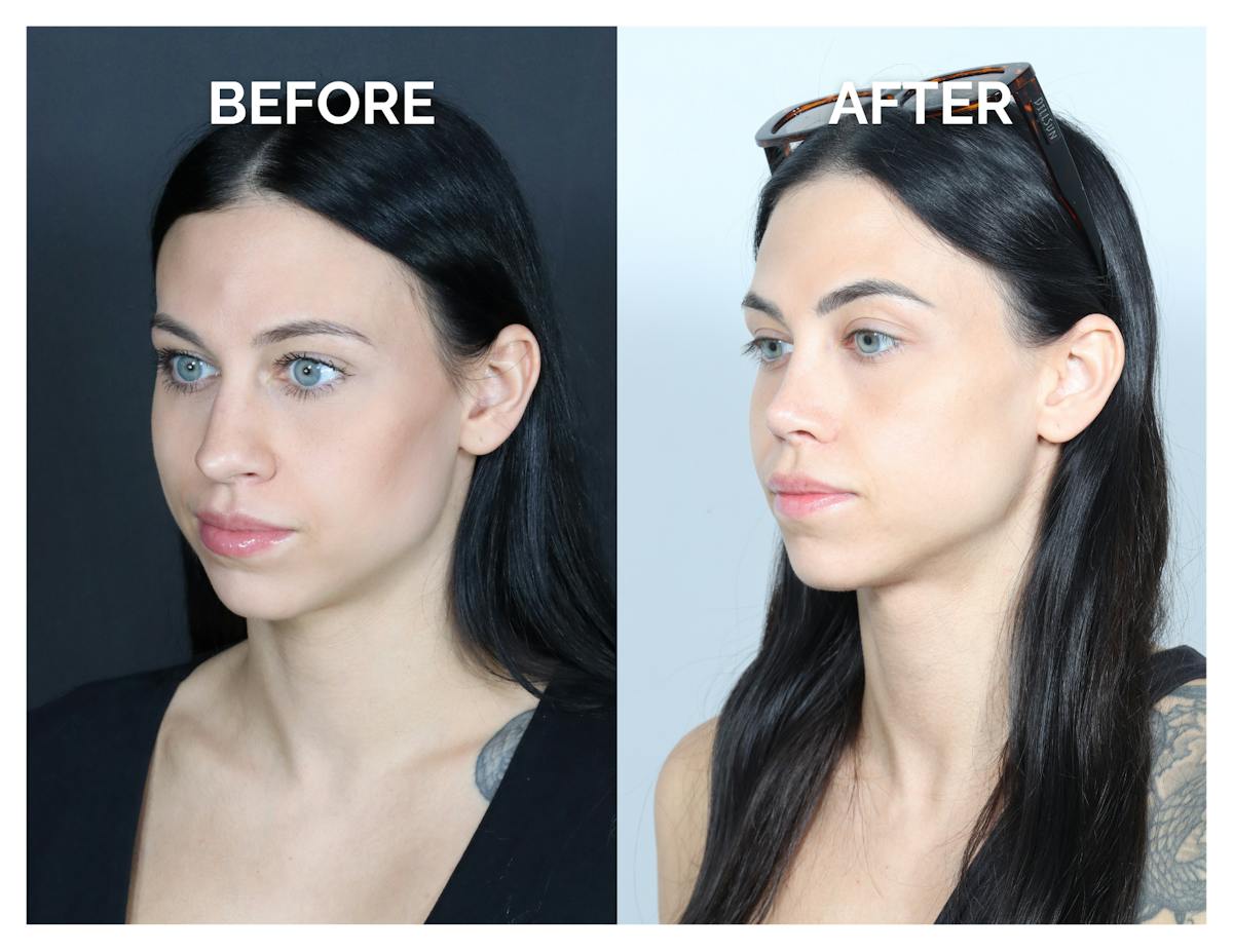 Rhinoplasty Before & After Gallery - Patient 345056 - Image 3