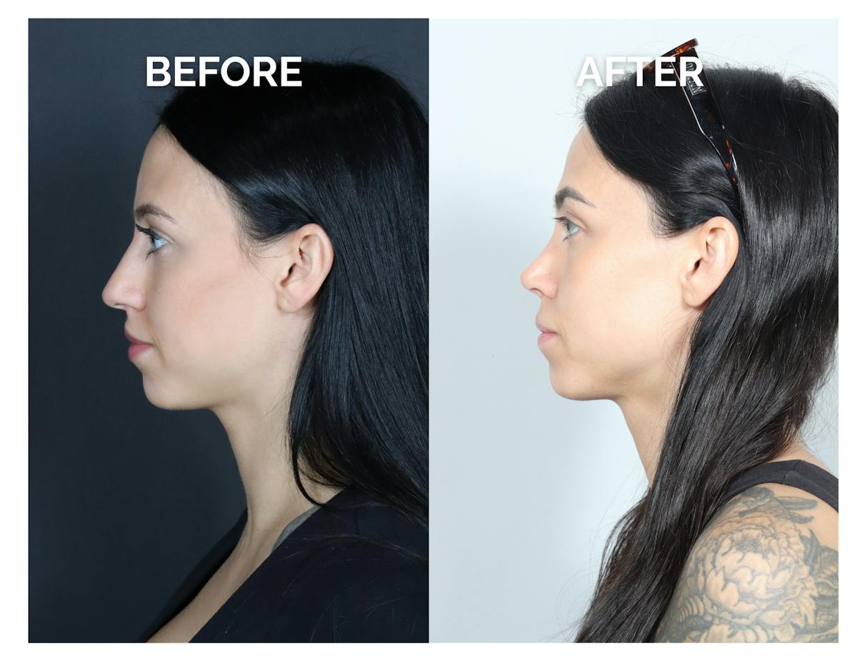 Rhinoplasty Before & After Gallery - Patient 345056 - Image 2
