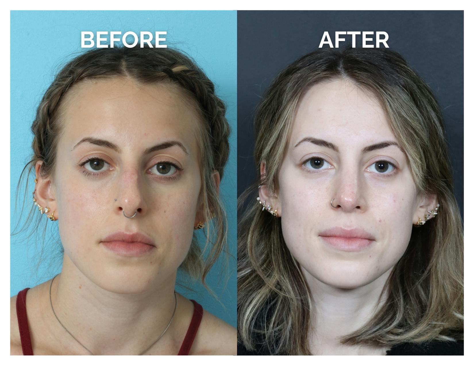 Rhinoplasty Before & After Gallery - Patient 324853 - Image 4