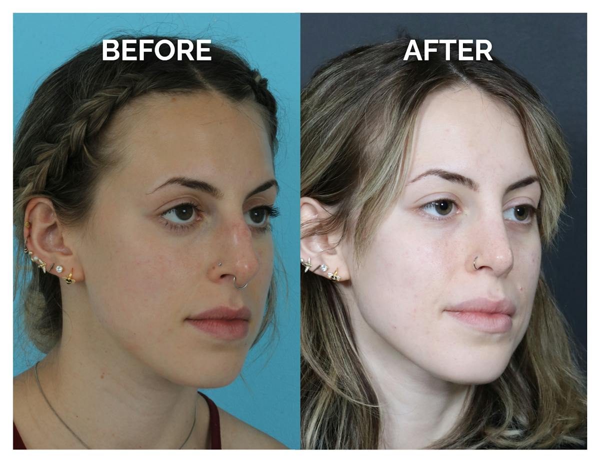 Rhinoplasty Before & After Gallery - Patient 324853 - Image 1