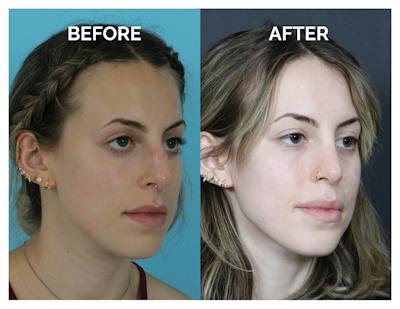 Rhinoplasty Before & After Gallery - Patient 324853 - Image 1