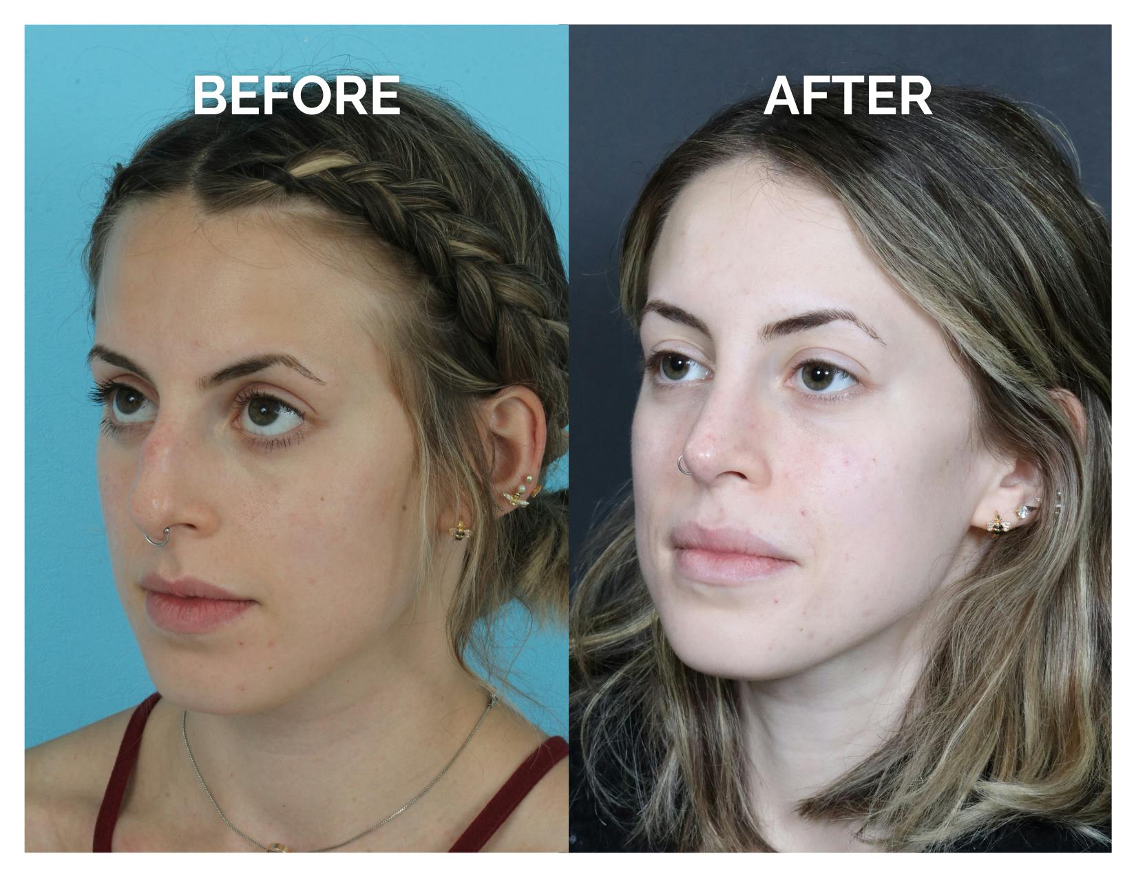 Rhinoplasty Before & After Gallery - Patient 324853 - Image 2