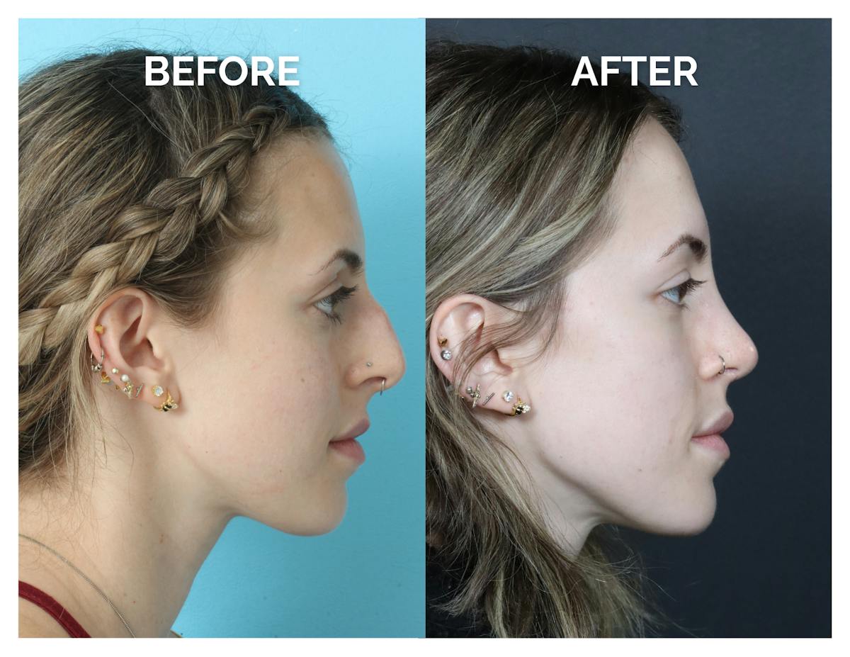 Rhinoplasty Before & After Gallery - Patient 324853 - Image 3