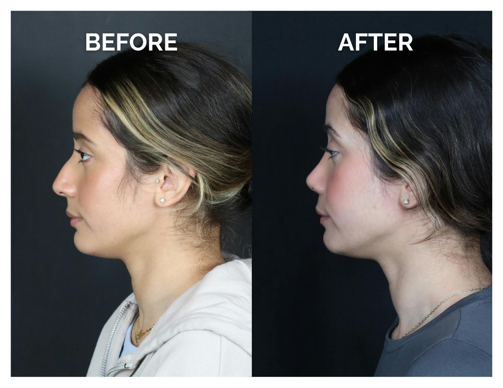 Rhinoplasty Before & After Gallery - Patient 274487 - Image 6