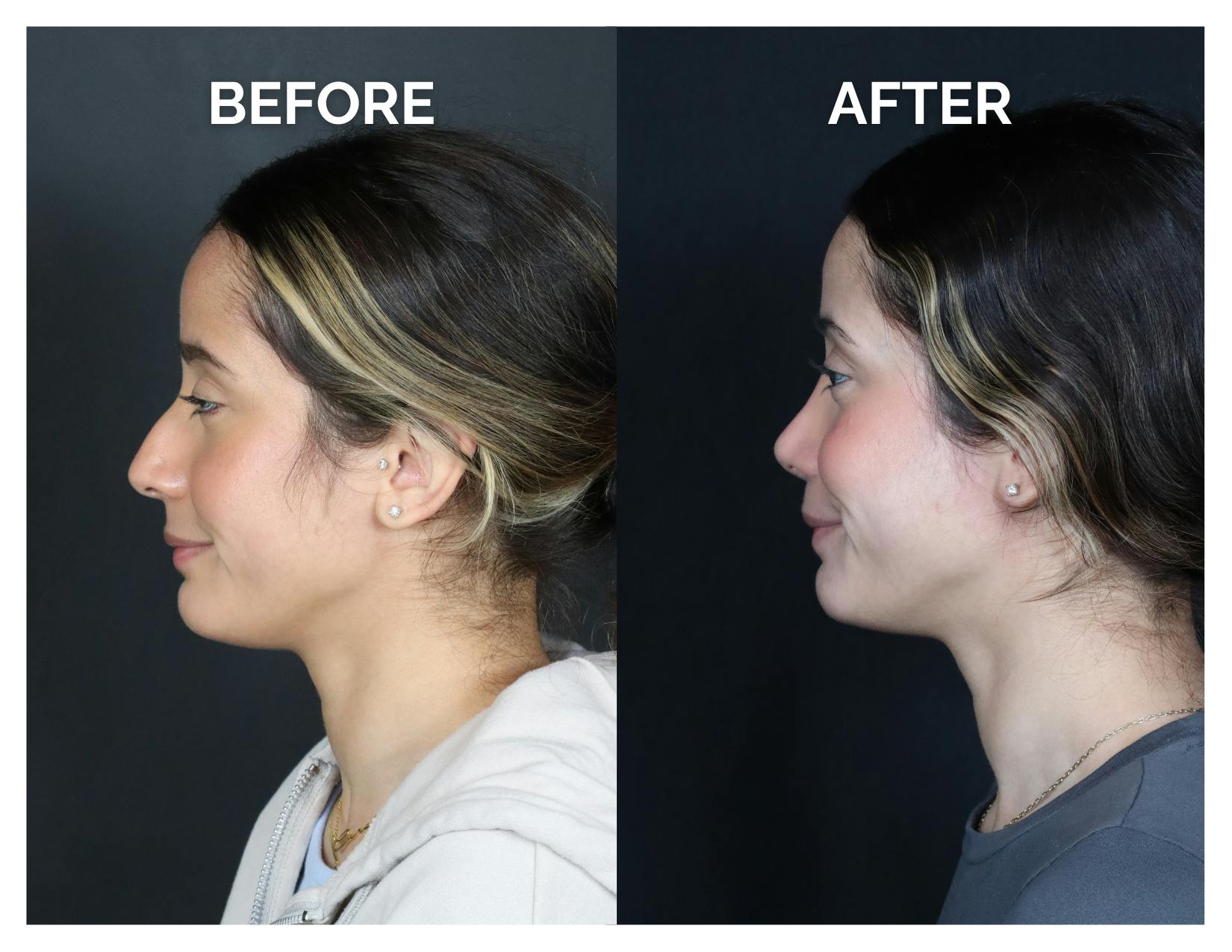 Rhinoplasty Before & After Gallery - Patient 274487 - Image 7