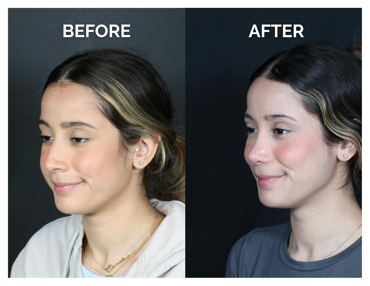 Rhinoplasty Before & After Gallery - Patient 274487 - Image 5