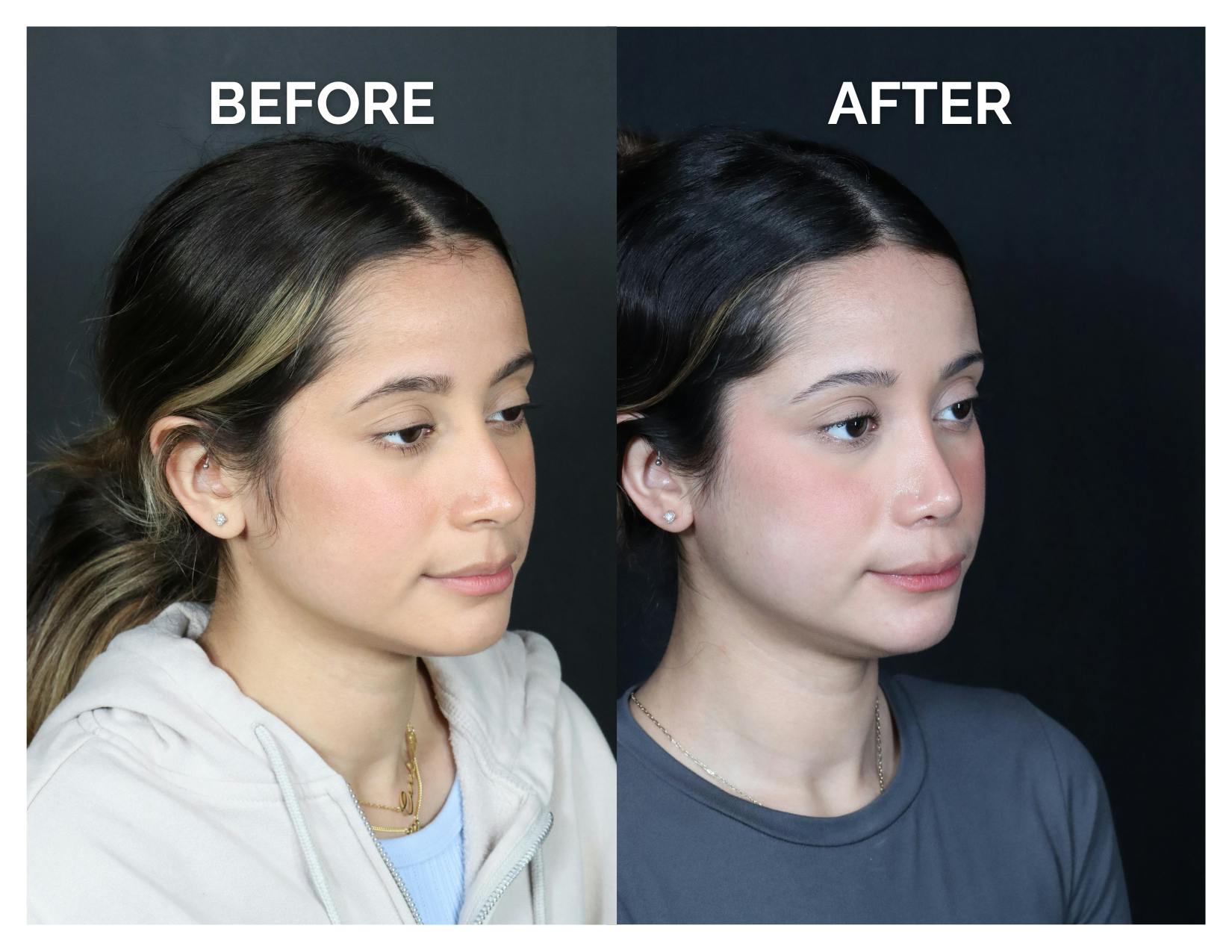 Rhinoplasty Before & After Gallery - Patient 274487 - Image 1