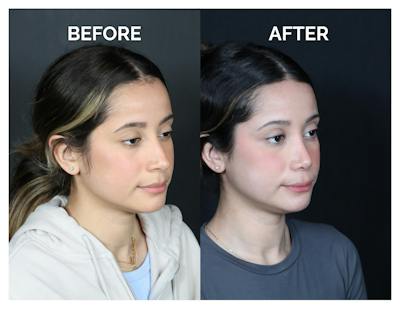 Rhinoplasty Before & After Gallery - Patient 274487 - Image 1