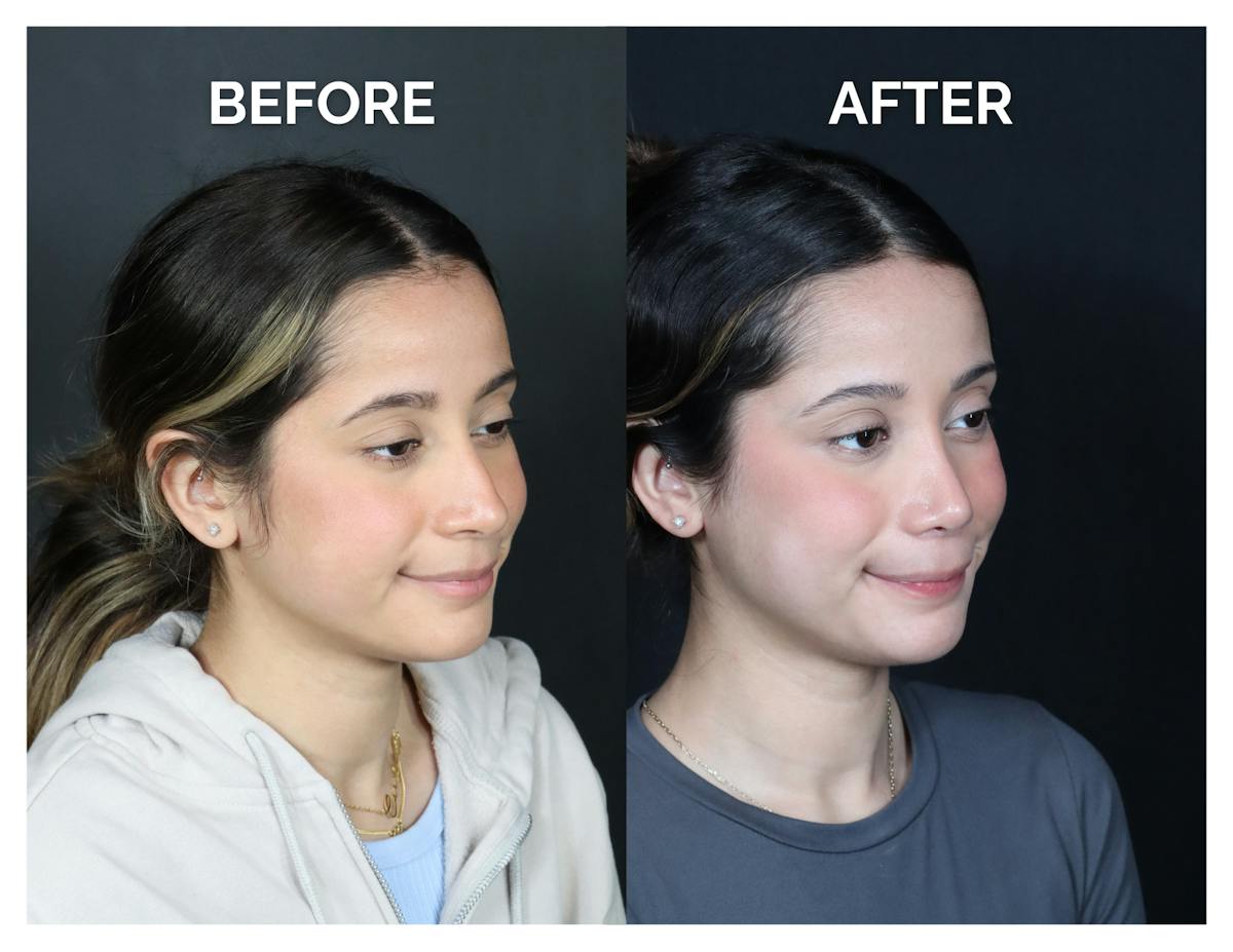Rhinoplasty Before & After Gallery - Patient 274487 - Image 2