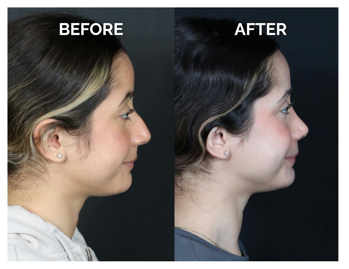 Rhinoplasty Before & After Gallery - Patient 274487 - Image 3