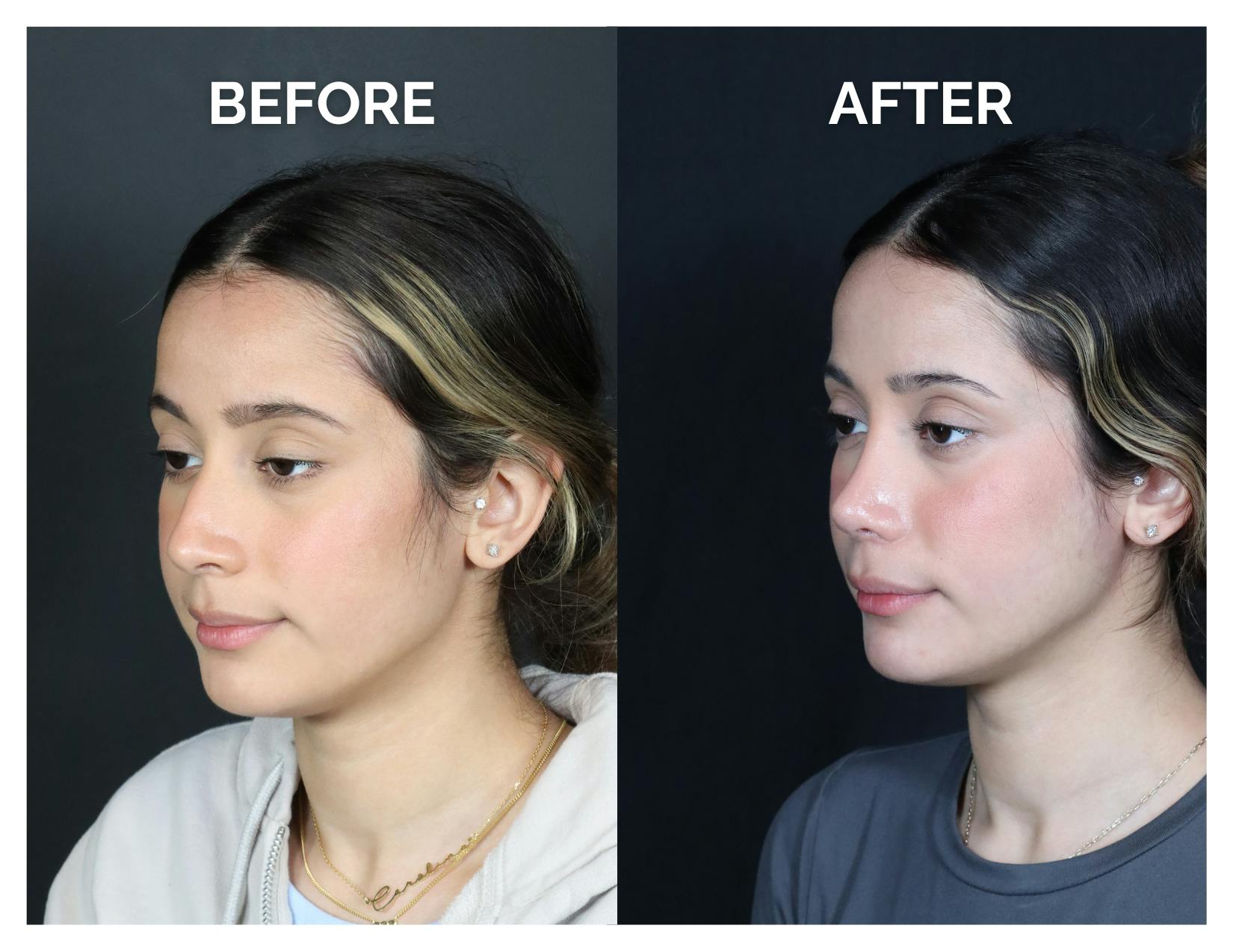 Rhinoplasty Before & After Gallery - Patient 274487 - Image 4