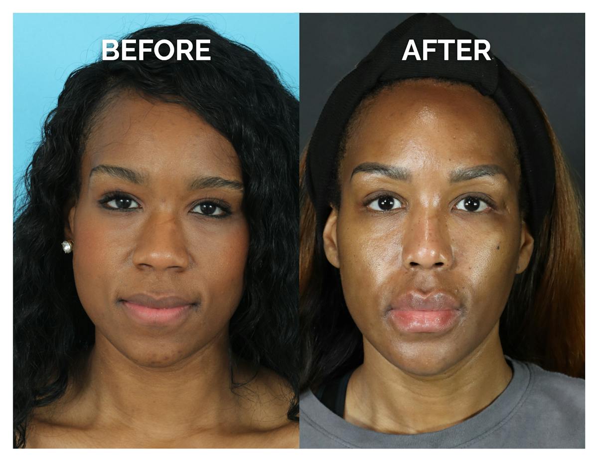 Rhinoplasty Before & After Gallery - Patient 213820 - Image 4